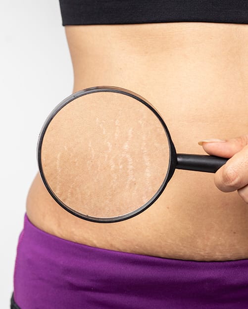 Stretch Marks Treatment in Gurugram at Aesthetics Redefined